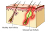 Blocked Follicle